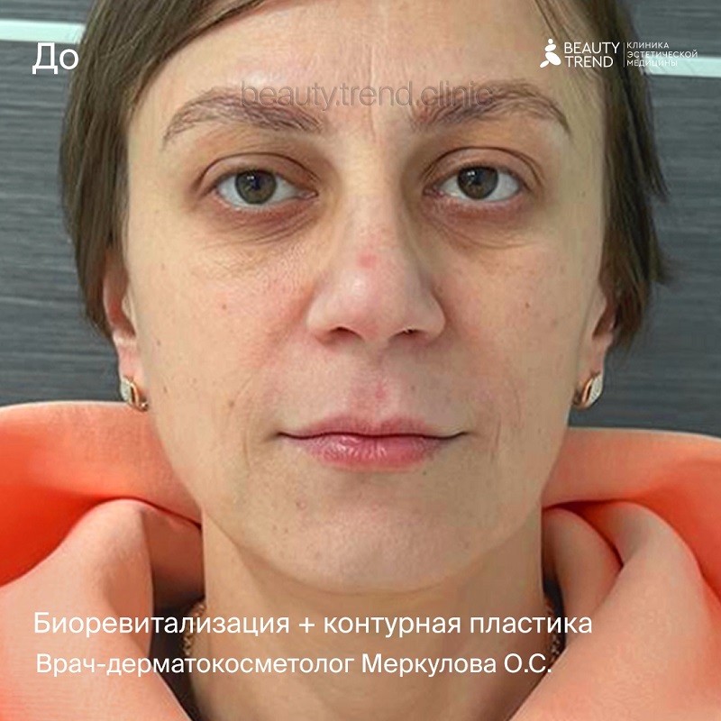 Биоревитализация + Контурная пластика, Меркулова - до 1